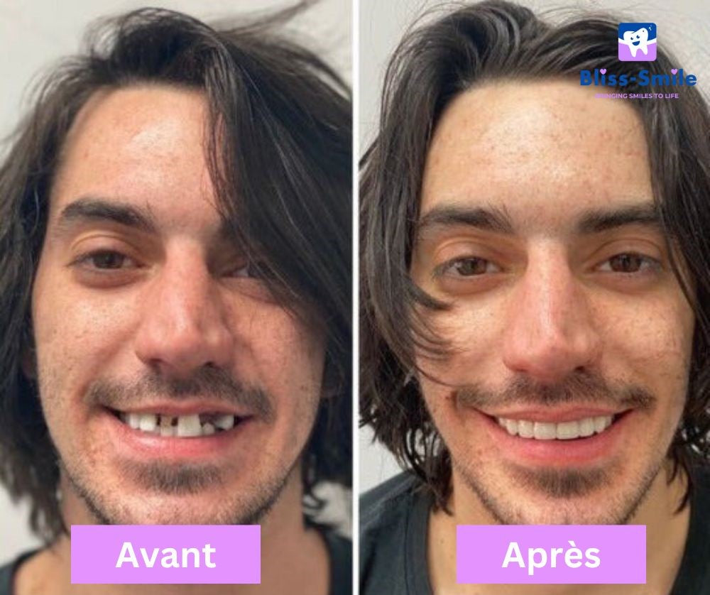 Bliss-Smile® Facettes en silicone